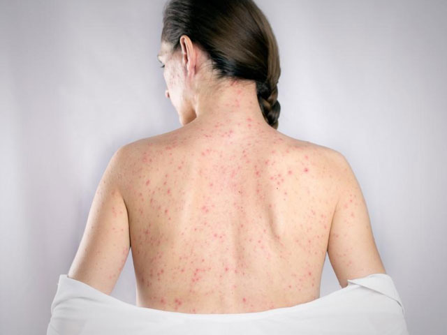 Shingles – Causes, Symptoms and Treatment